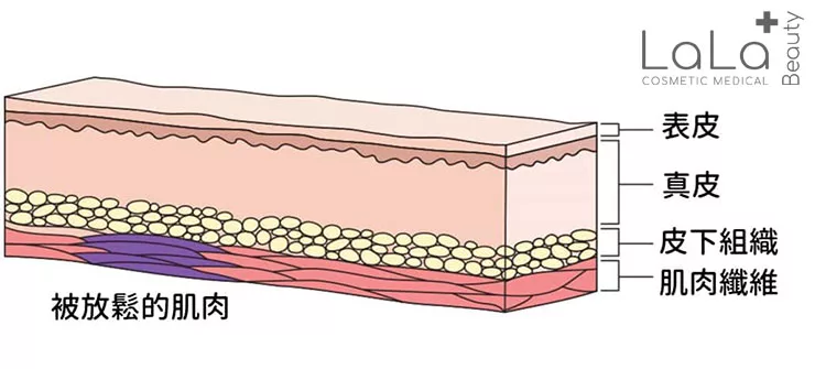 【瘦面祛皺】Botox A型肉毒桿菌素針劑 全球第一獲美國FDA認可