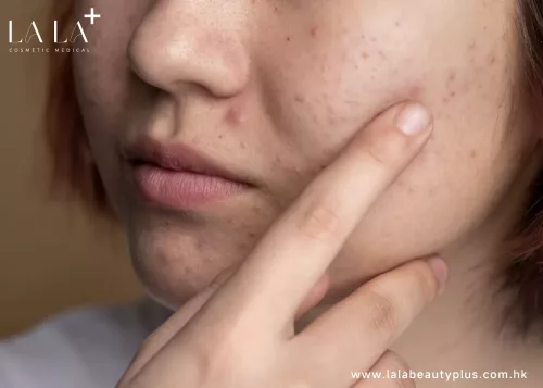 如何治療不同類型的暗瘡肌膚